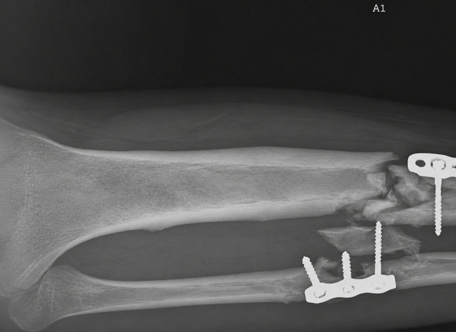 Fracture 2