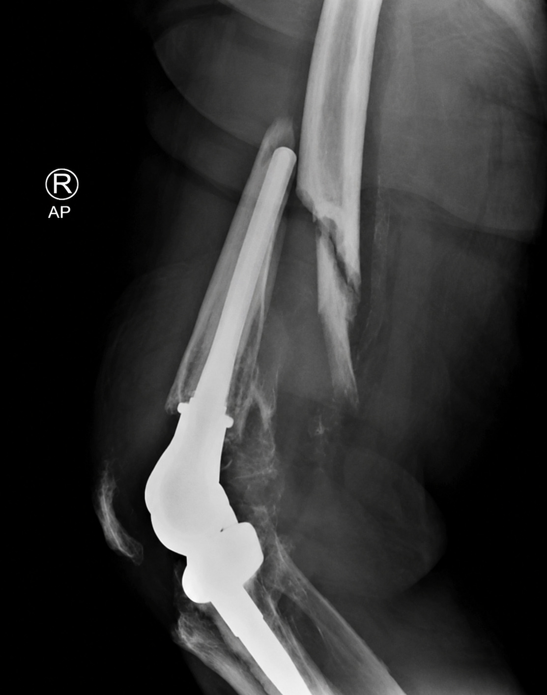 Fractures