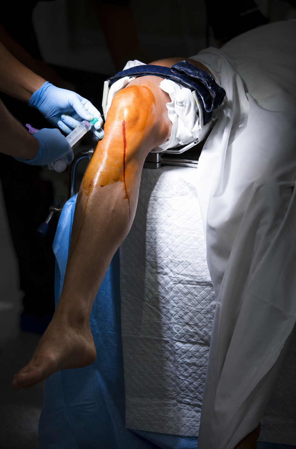 Meniscus