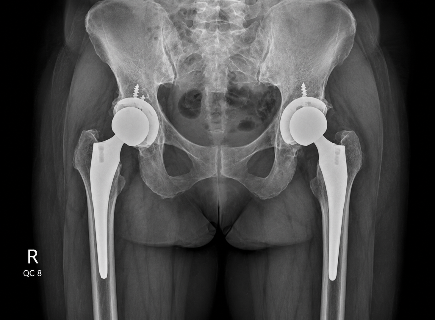 Hip Reconstruction